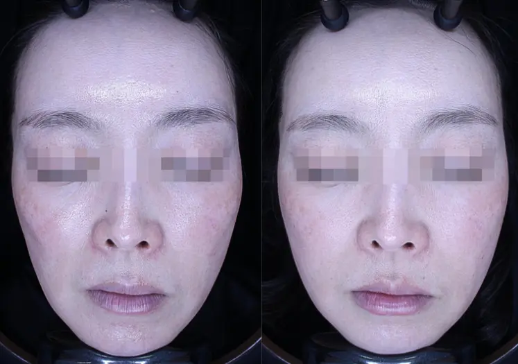 Photos Showing Juvelook Volume Is More Suitable than Radiesse for Cheek Hollows