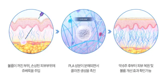 쥬베룩볼륨의 PDLLA 성분이 콜라겐 합성을 유도하는 모습