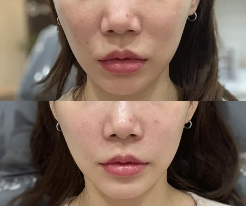 실제 팔자주름 쥬베룩볼륨 효과