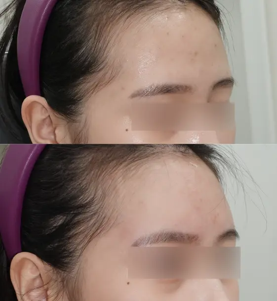 이마꺼짐은 필러 시술이 더 적합