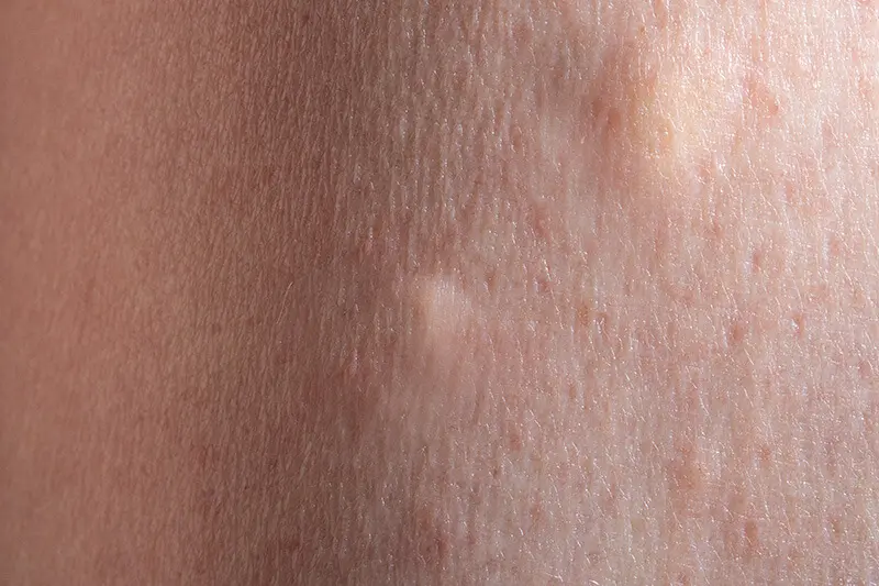 쥬베룩볼륨 결절 부작용 사진