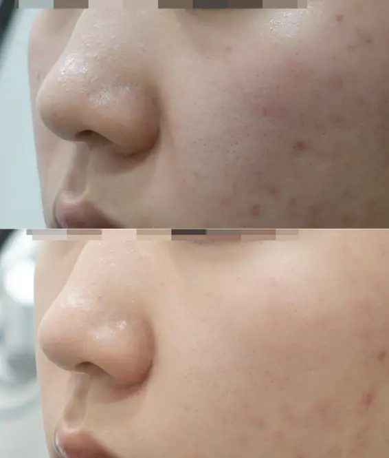 Nasolabial Fold Volume Improvement After Radiesse Treatment