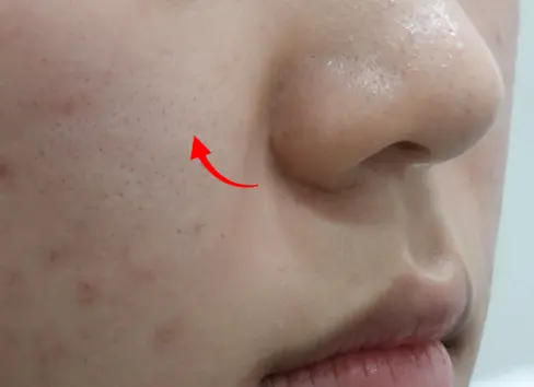 Mobility of Nasolabial Fold Fillers