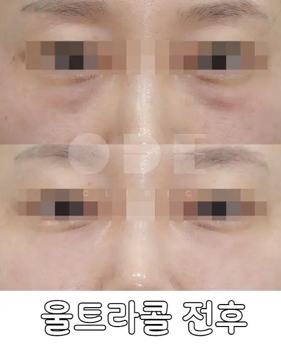 눈밑 울트라콜 200 전후 효과