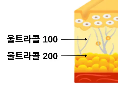 울트라콜 100, 200 주입 층 비교