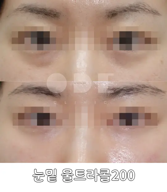 실제 눈밑 울트라콜 200 시술 전후