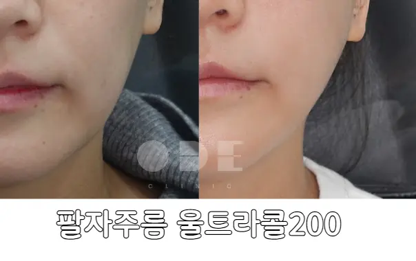 실제 팔자주름 울트라콜 200 시술 전후