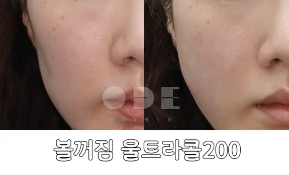 실제 볼꺼짐 울트라콜 200 시술 전후