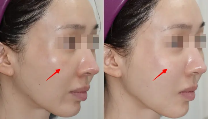 HiloWave Mid-Face Treatment Effect
