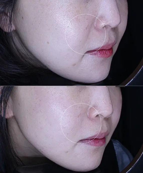 Before and After Xerf 300 shots