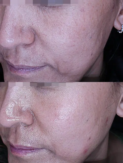 Tightening Focused in Traditional RF