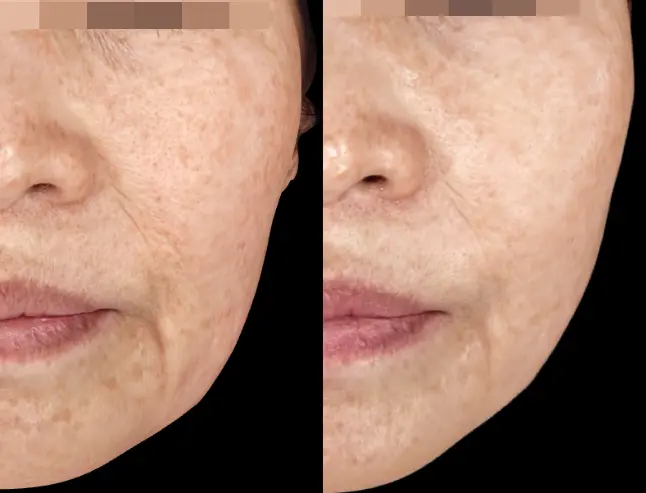 Before and After Xerf Lifting Treatment