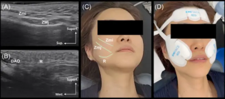 엠페이스 리프팅 원리