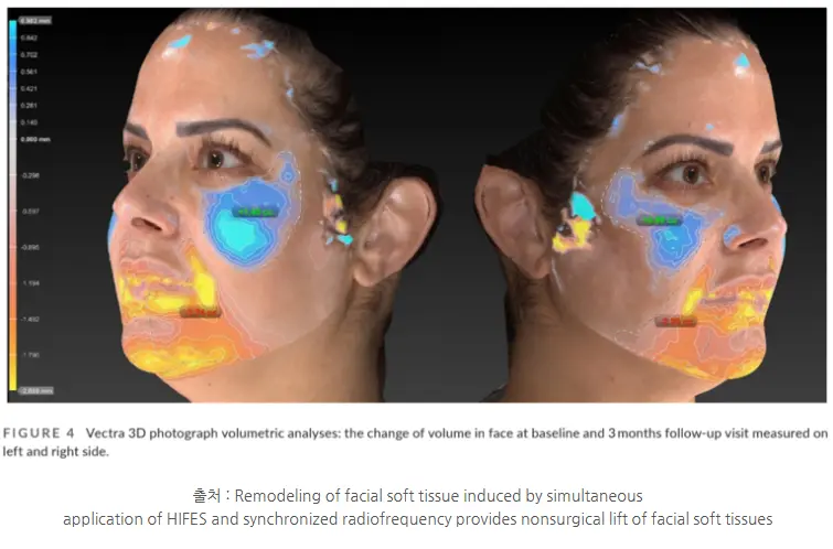 EmFace Effect: Increased mid-face volume