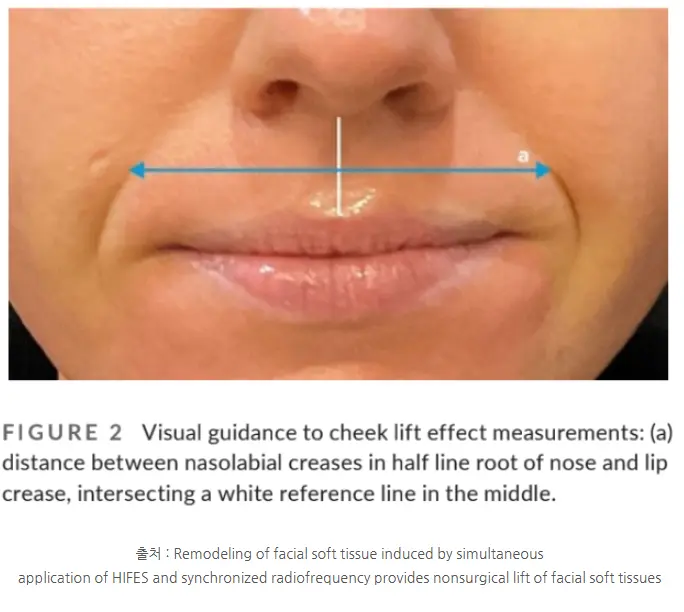 EmFace Effect: Mouth-corner lifting