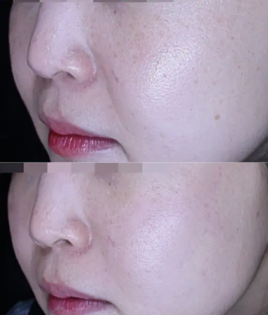 실제 강남 오드의원 엠페이스 시술 전후 사진