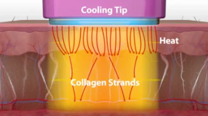 Thermage uses radiofrequency energy