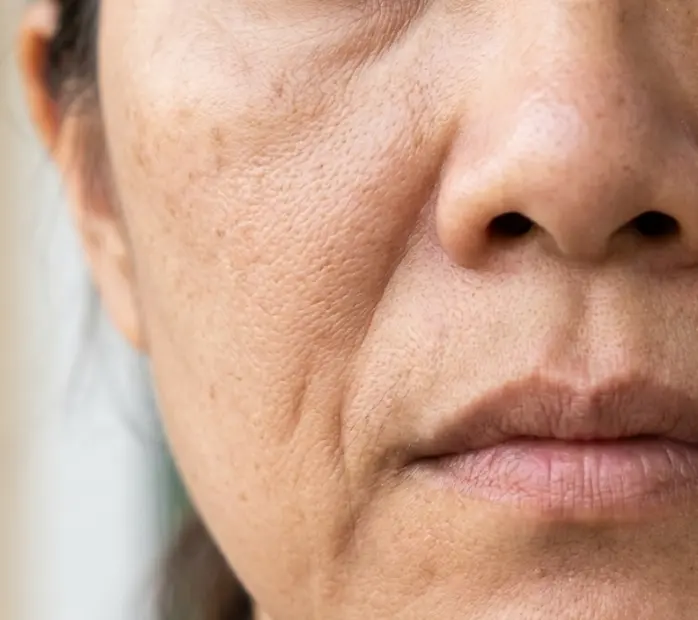 nasolabial crease 클로즈업 사진