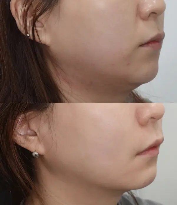 Before and After Coolsoniq Jawline and Double Chin Treatment