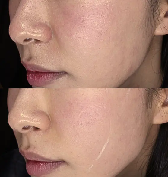 Before and After Coolsoniq Nasolabial Treatment