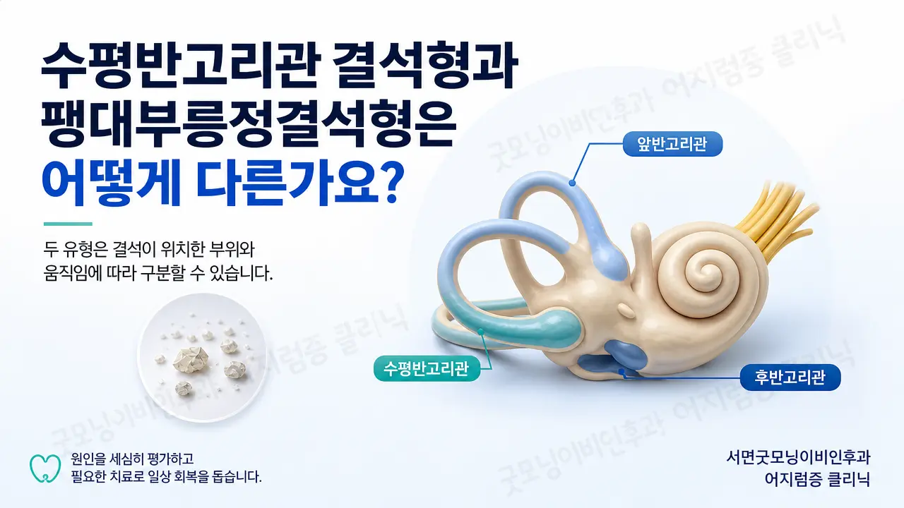 부산 이석증 | 수평반고리관 결석형과 팽대부릉정결석형은 어떻게 다른가요?