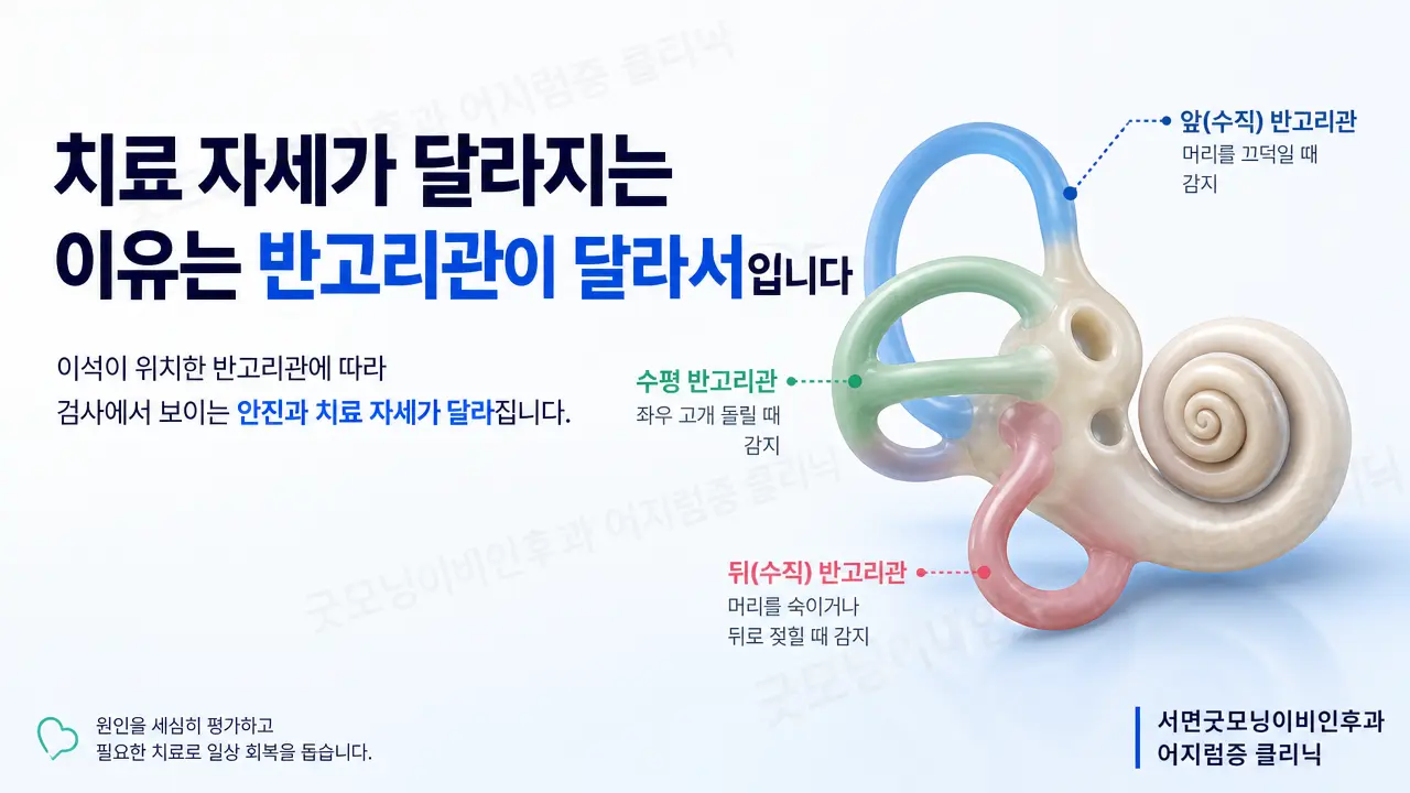 부산 이석증 치료 | 수평반고리관 이석증에 사용하는 치료 자세는 왜 달라지나요?