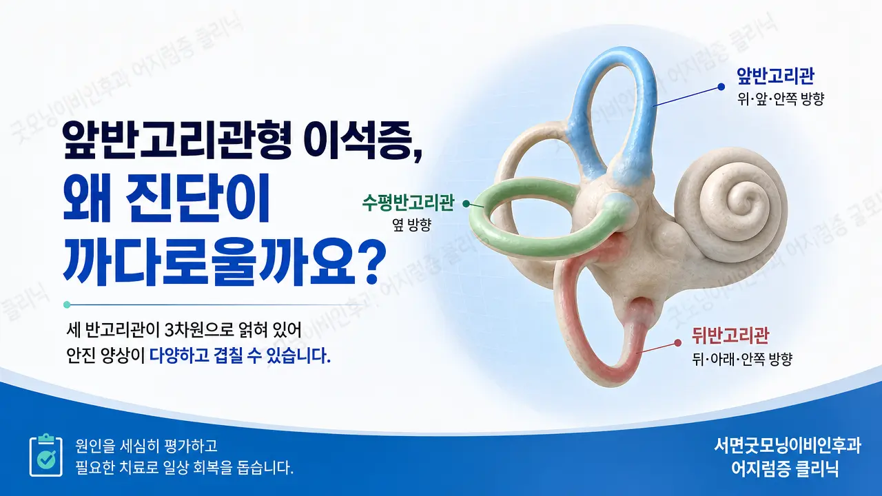 부산 이석증 | 앞반고리관형 이석증은 왜 진단이 까다로운가요?