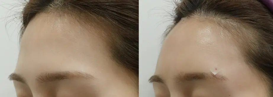 이마필러 시술 전후 비교 사진