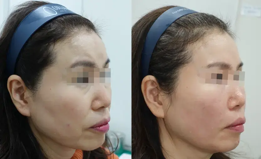 Combined Juvelook Volume + Filler B/A