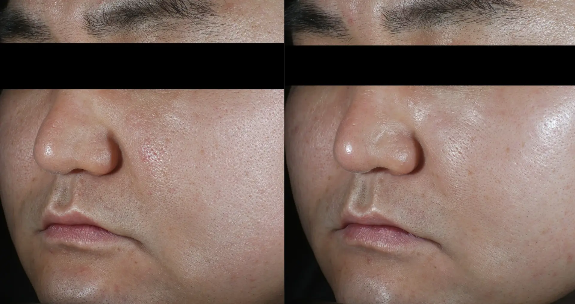 Re2O Skin Booster Effect on Wrinkle and Pore Improvement