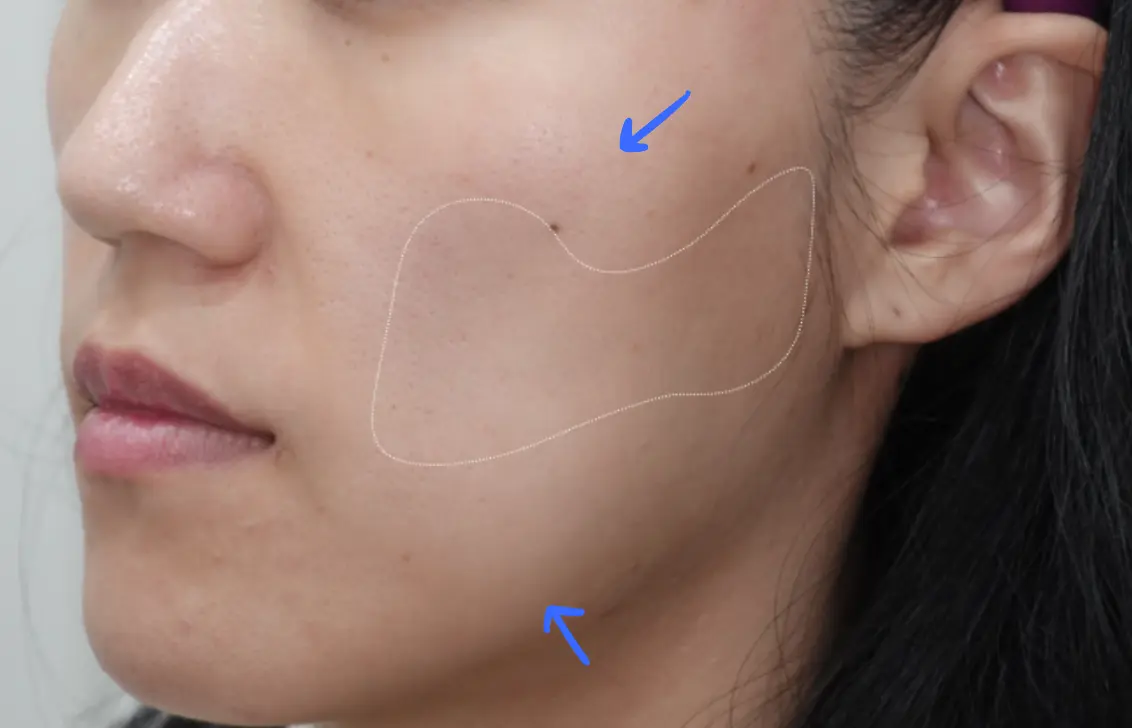 Recommended Treatments for Sunken Cheeks: Juvelook Volume, Fillers, and Sculptra