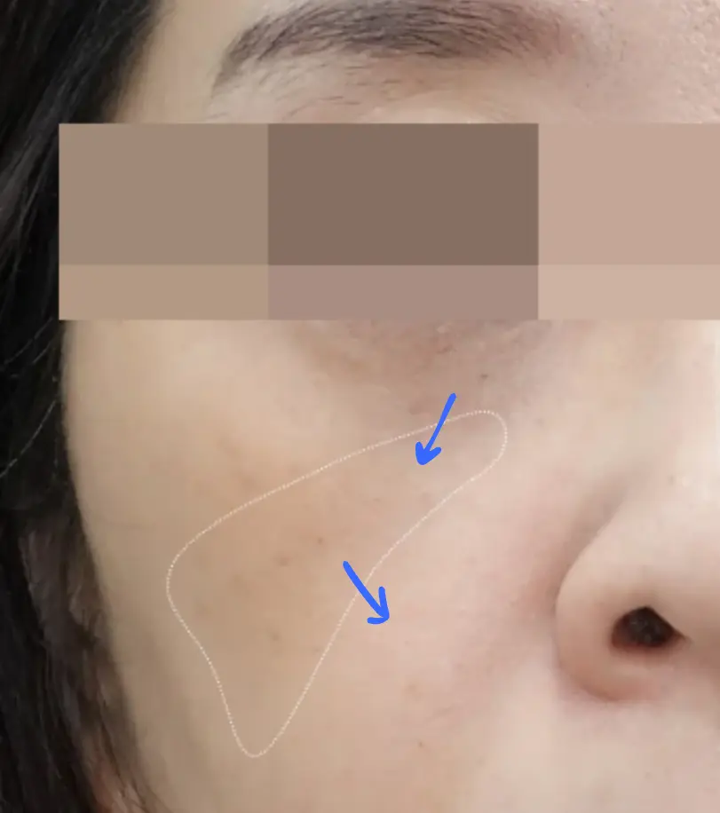 Recommended Volume Treatments for Tear Troughs and Anterior Cheeks