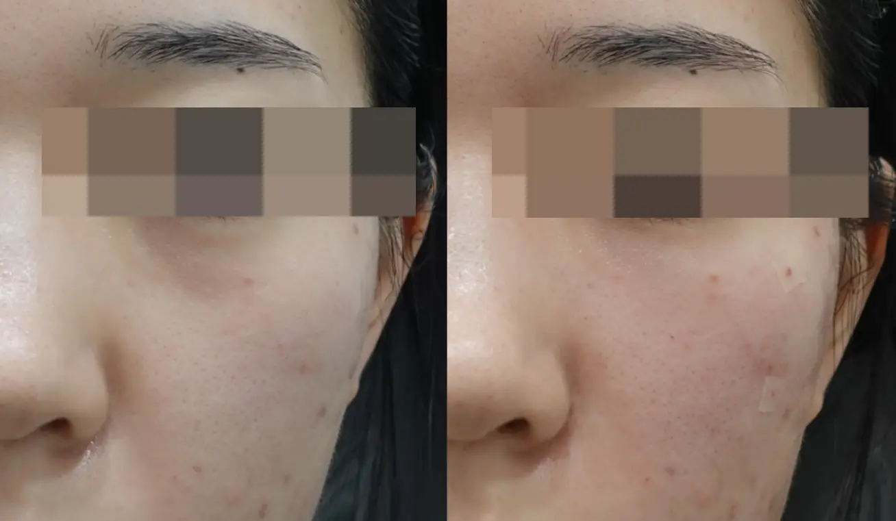 Before and After Volume Treatment for Tear Troughs and Anterior Cheeks