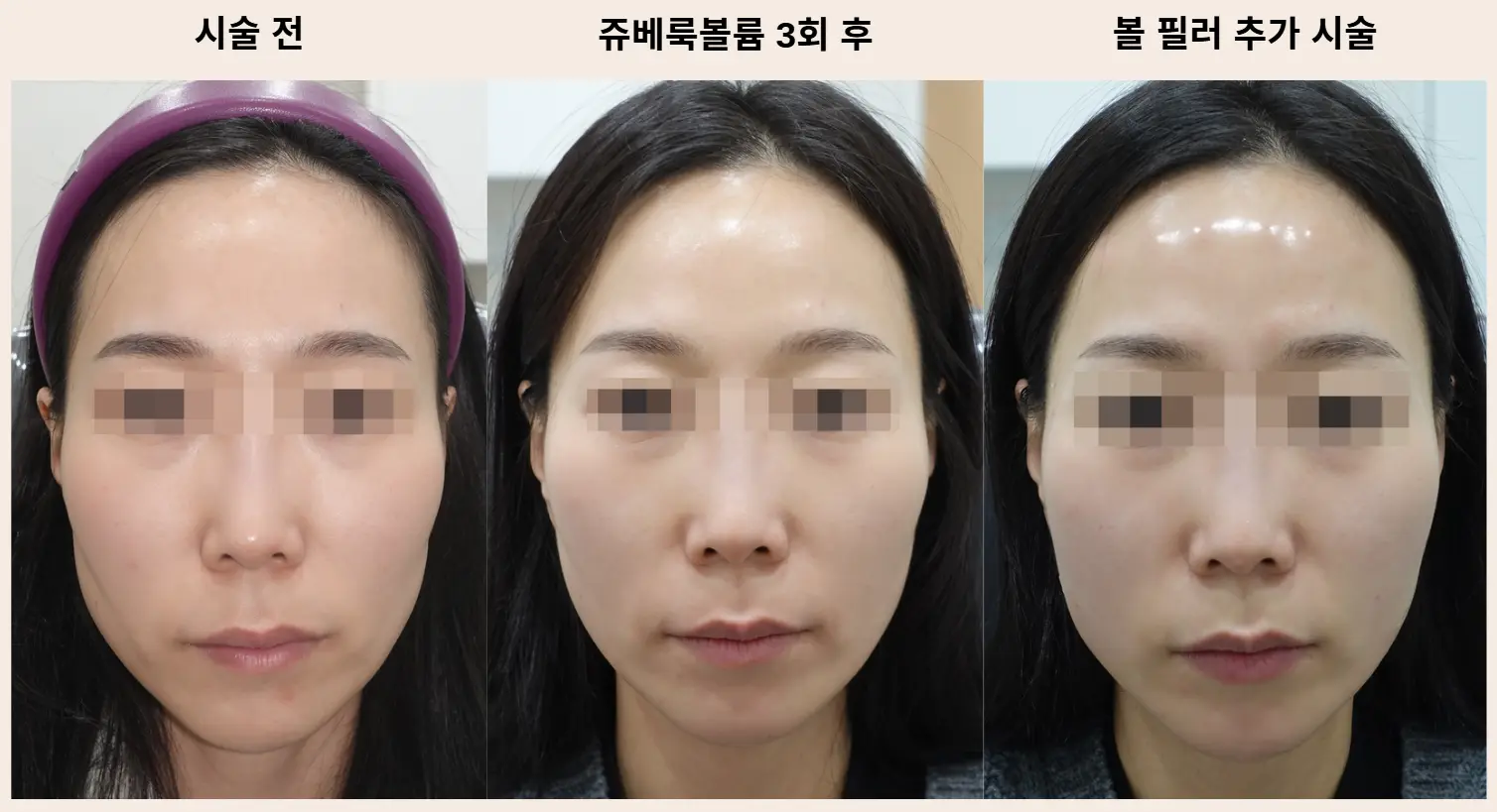 쥬베룩볼륨, 필러 볼륨 효과. 전후 비교