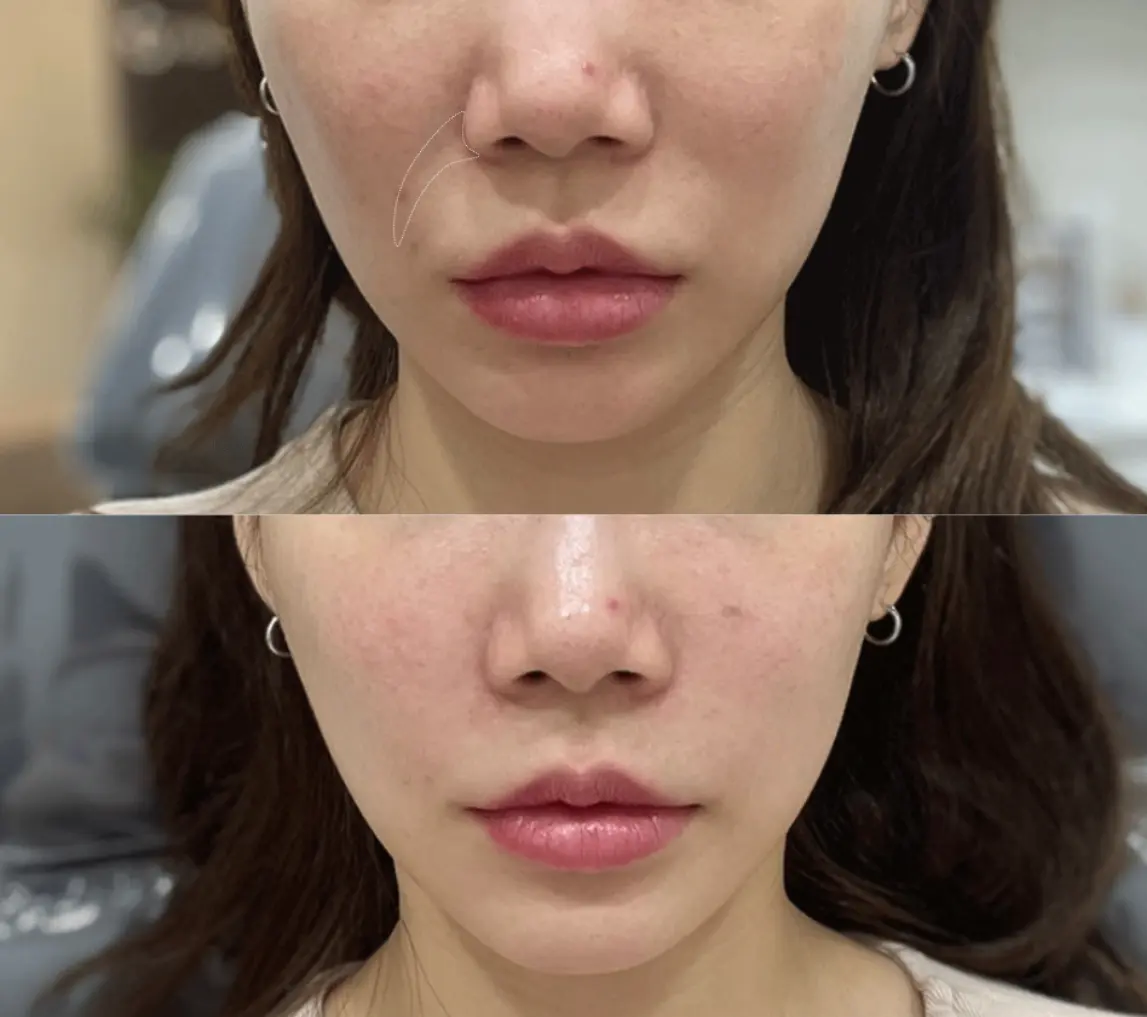 콜라겐부스터 레디어스 팔자주름 시술 전후