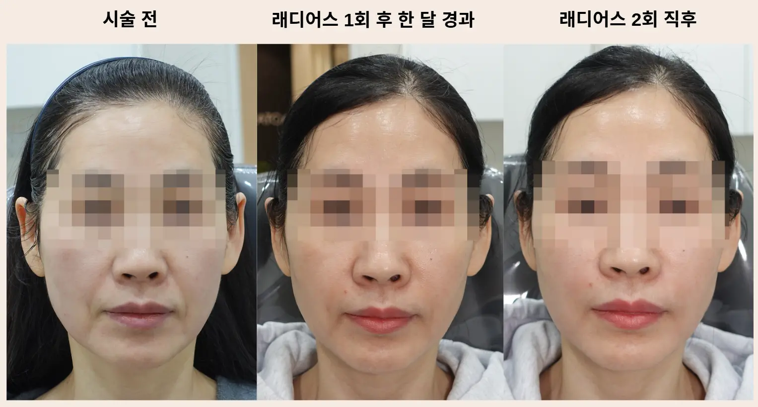 레디어스 2회 시술 효과 비교 