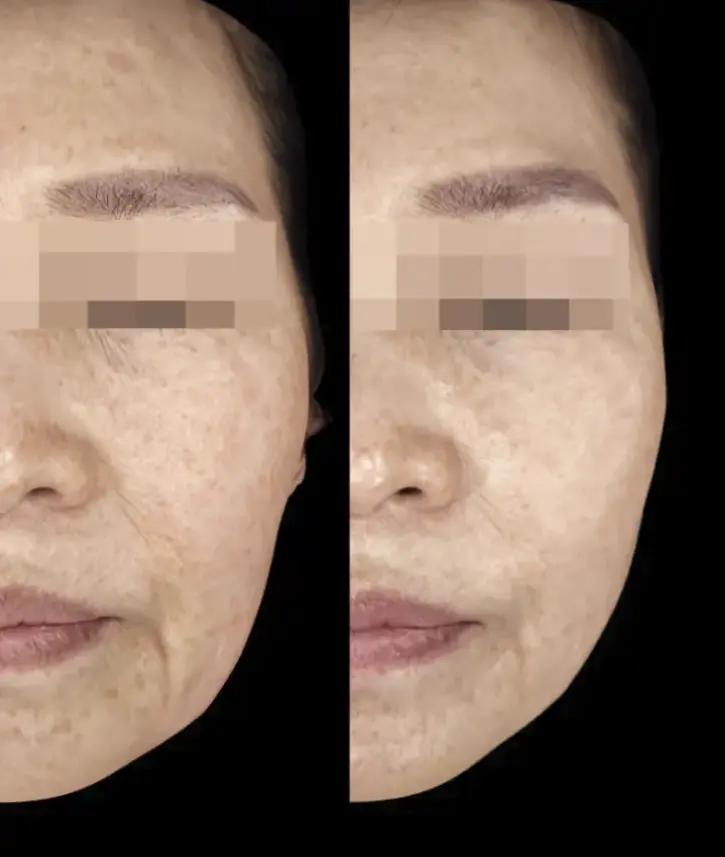 Lifting Treatments Improve Sagging in Areas Like Nasolabial Folds and Jawline