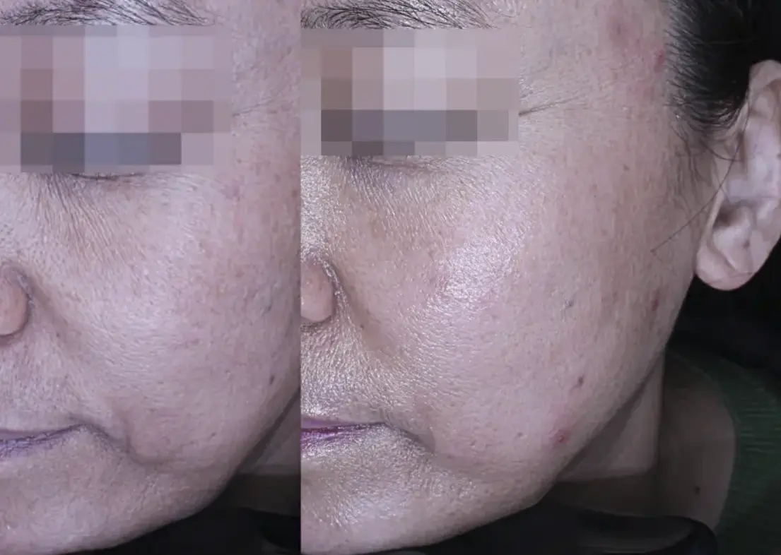 Tightening Treatments Enhance Skin Elasticity and Help Prevent Sagging