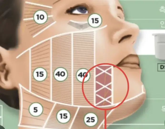 Perioral Areas Prone to Ultherapy Side Effects