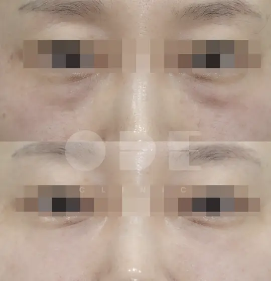 Actual UltraCol 200 under-eye results