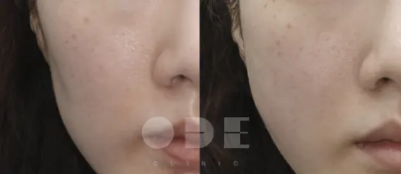 Actual UltraCol 200 cheek-hollowness results