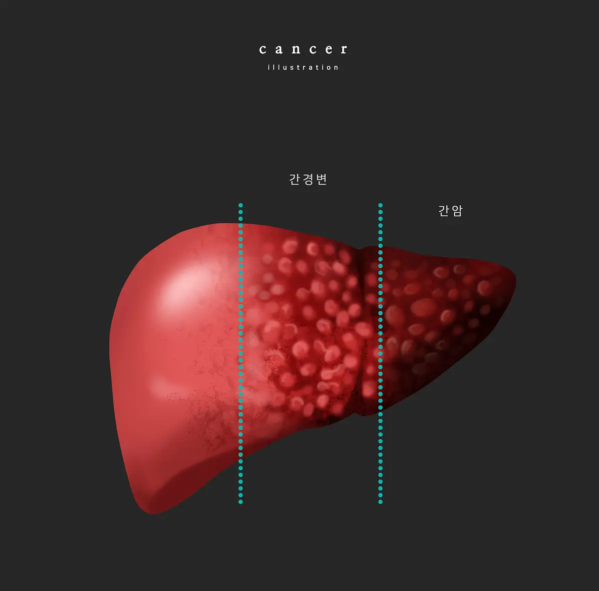 간암 원인과 치료방법 | 힐링오아시스