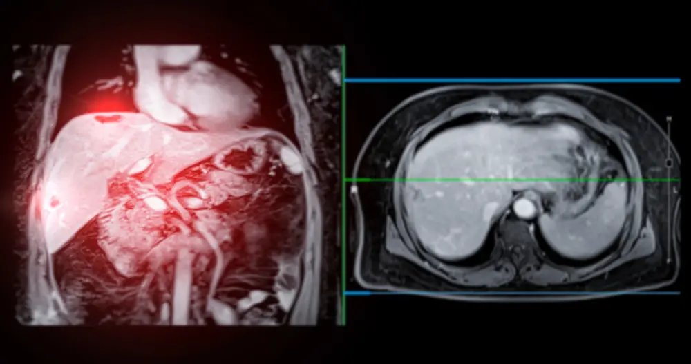 간암 원인과 치료방법 | 힐링오아시스