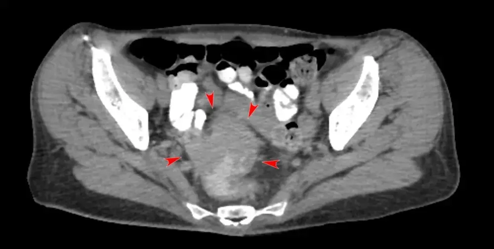 조기 발견 시 생존율과 치료 방법