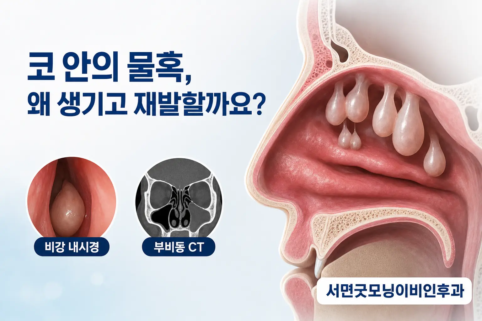 부산이비인후과 | 코 안의 물혹인 비용종은 왜 생기고 재발할까요?