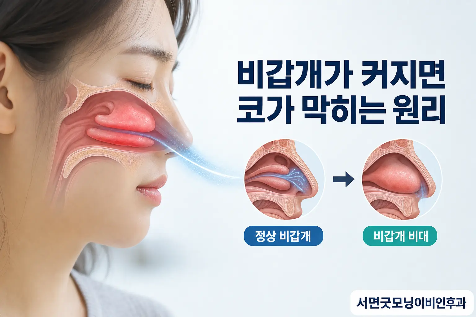 부산이비인후과 | 비갑개가 크면 코막힘이 생기는 원리