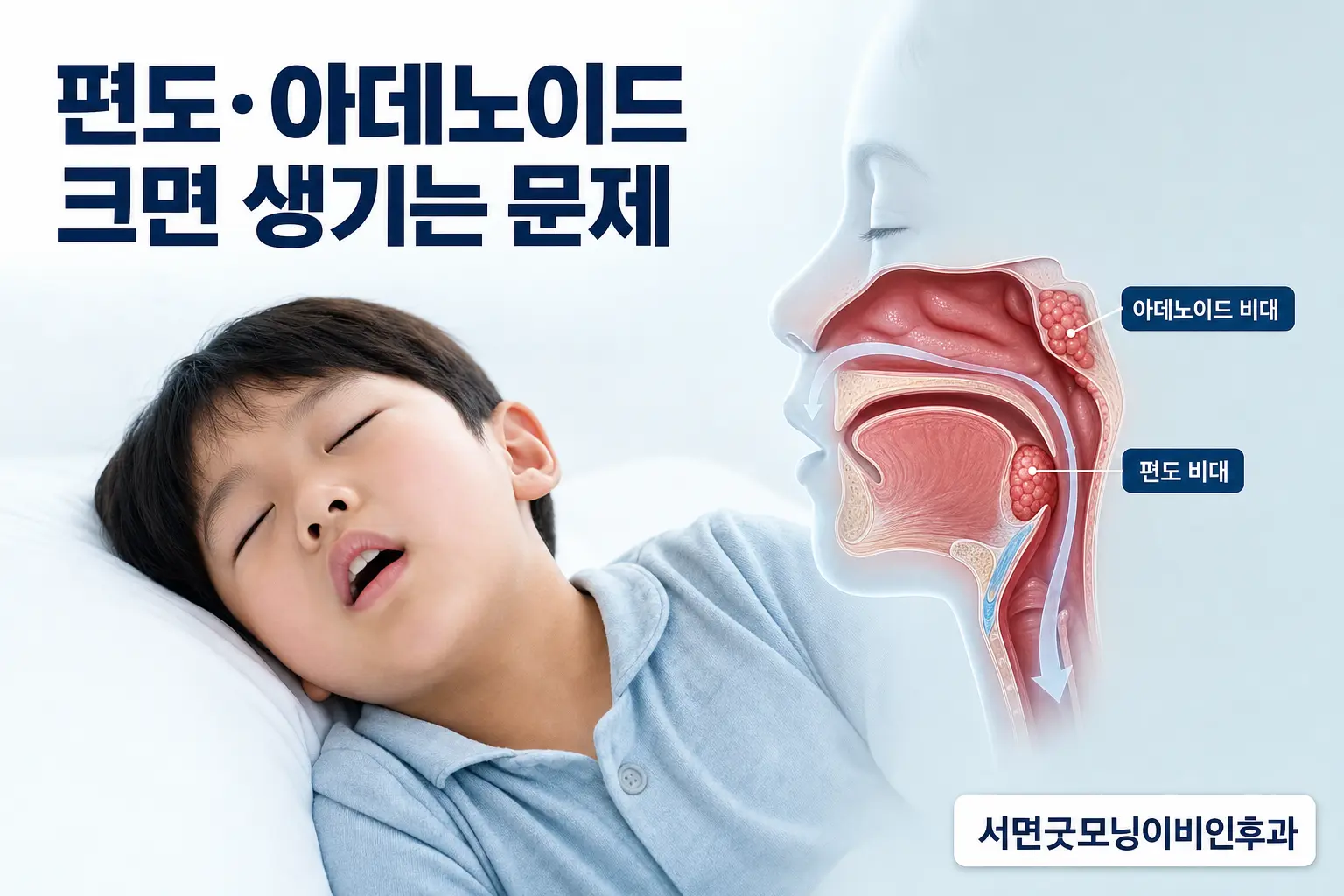 부산이비인후과 | 아이의 편도와 아데노이드가 크면 어떤 문제가 생길까요?