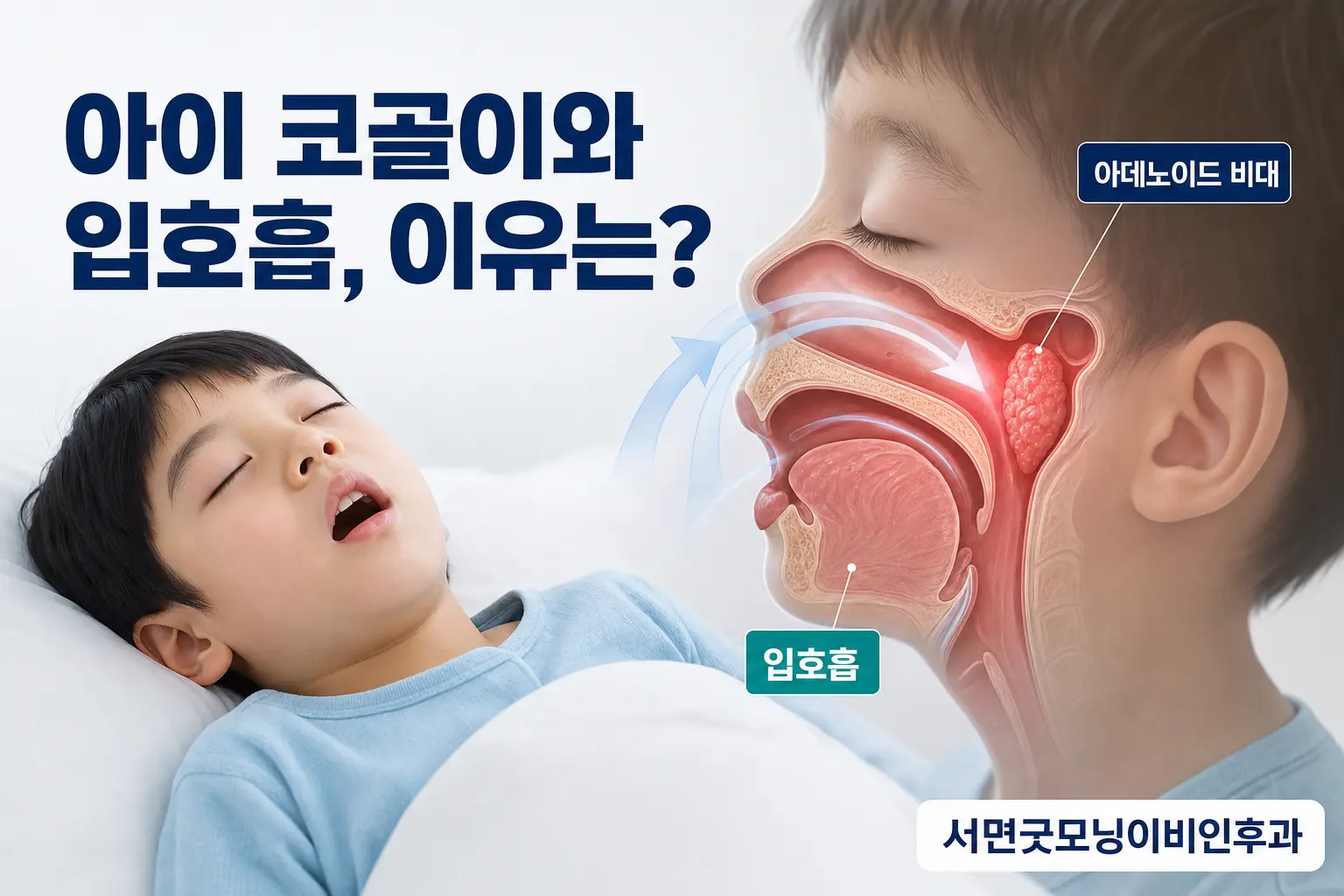 부산이비인후과 | 아이의 코골이와 입호흡, 아데노이드 비대 때문일까요?