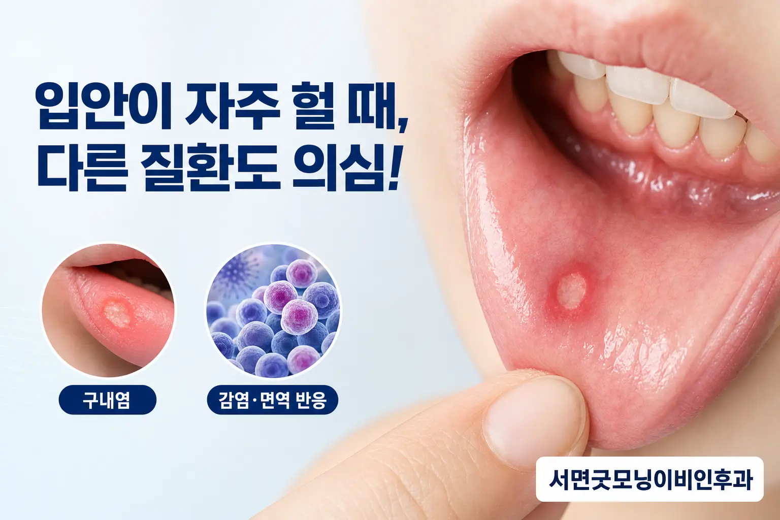 부산이비인후과 | 입안이 자주 헐 때 단순 구내염과 다른 질환을 구분하는 법