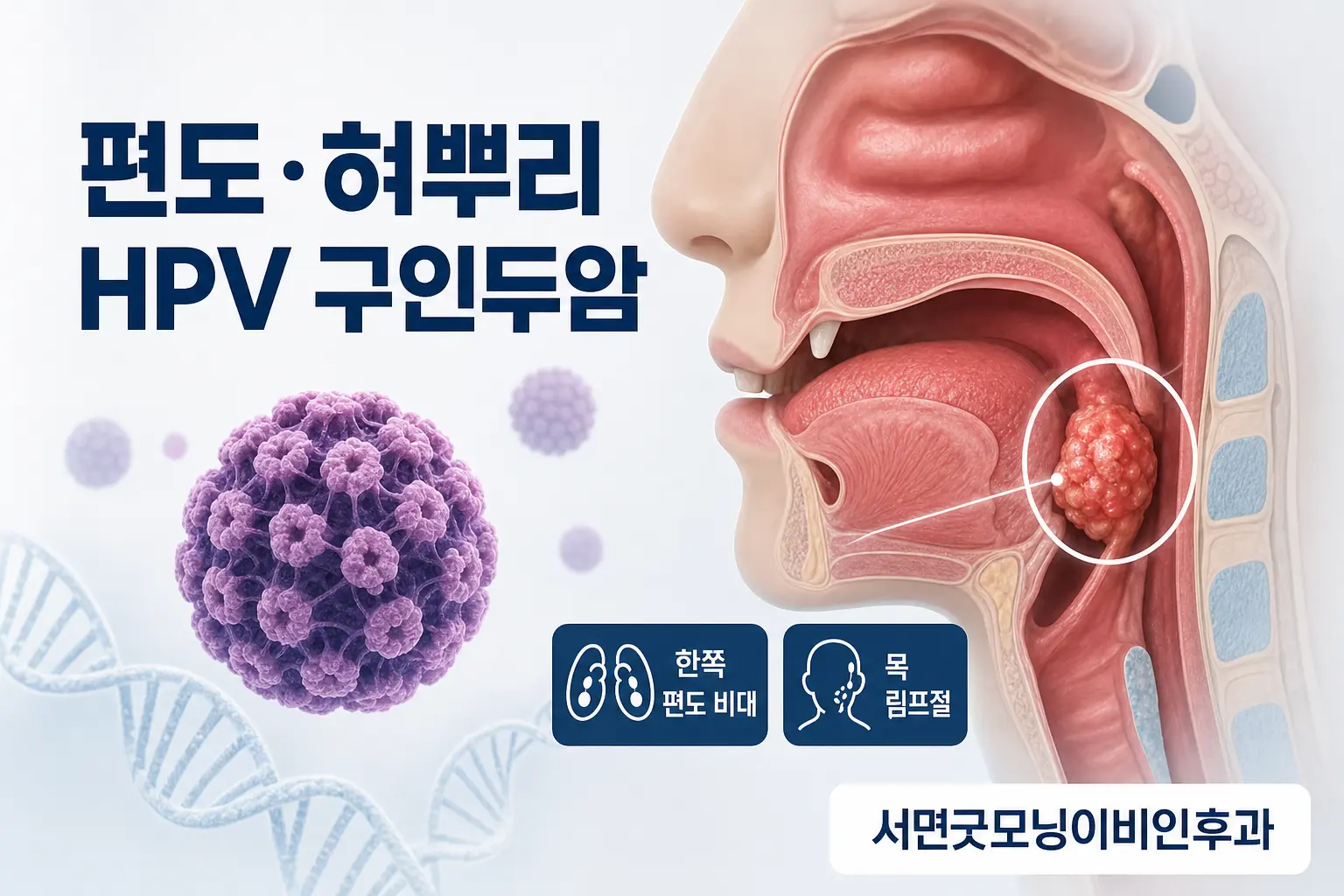 부산이비인후과 | 편도와 혀뿌리에서 생기는 HPV 관련 구인두암